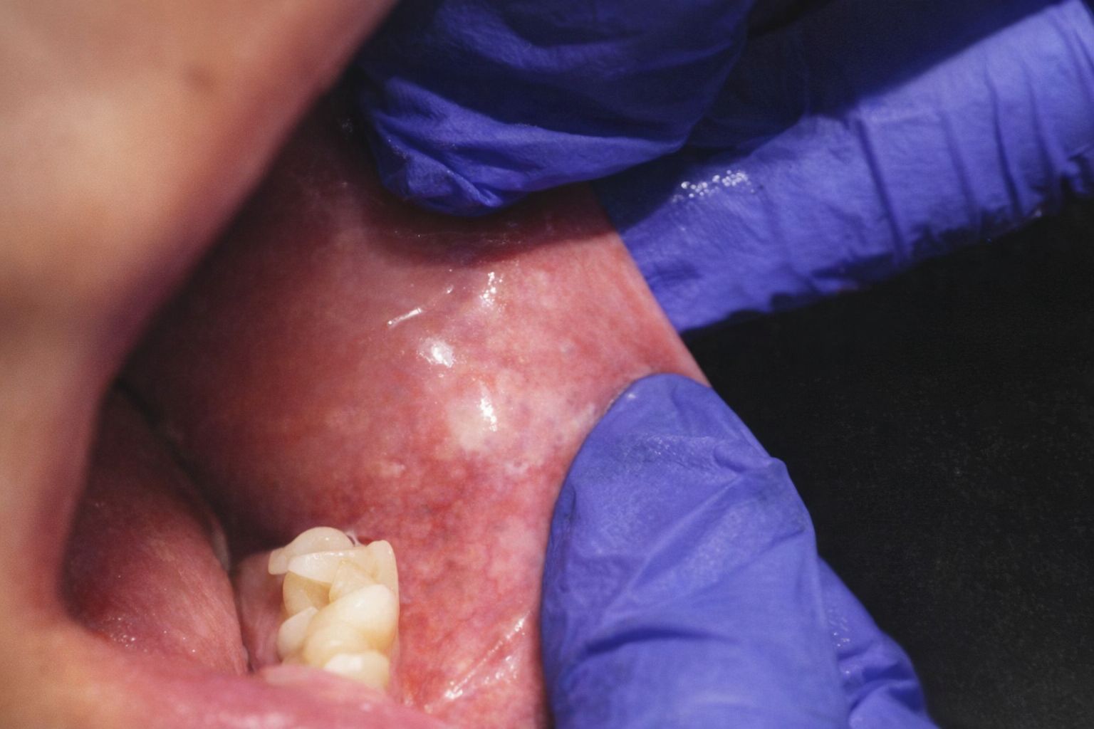 Närbild av munslemhinnan med tecken på oral lichen planus.